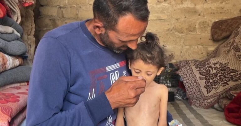 6-year-old-girl-in-Gaza-weighs-just-13-pounds-amid-growing.j.jpeg