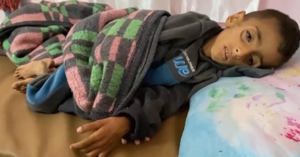 Gaza-doctor-says-lack-of-food-and-aid-has-led.jpg