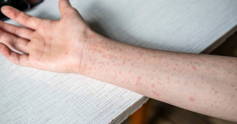 CDC-urges-summer-camps-to-check-for-measles-immunity-as.jpg