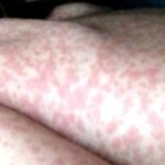 Doctors-face-new-challenge-as-US-measles-cases-hit-33-year.jpg