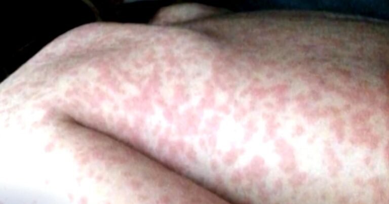 Doctors-face-new-challenge-as-US-measles-cases-hit-33-year.jpg