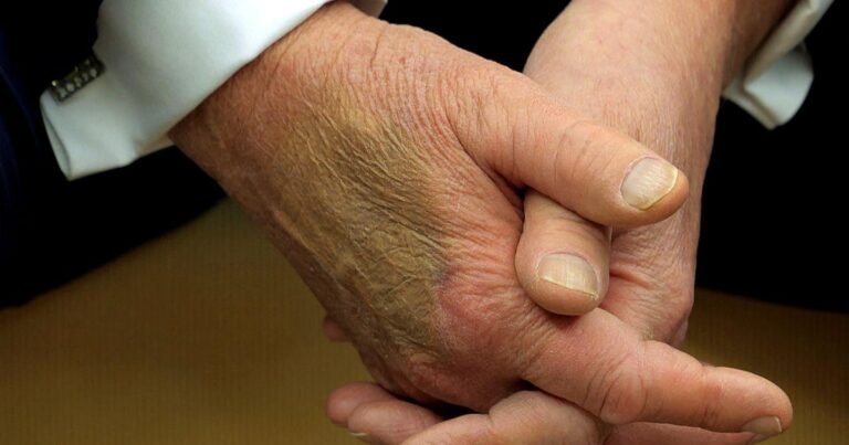 What-to-know-about-President-Trumps-chronic-venous-insufficiency-diagnosis.jpg